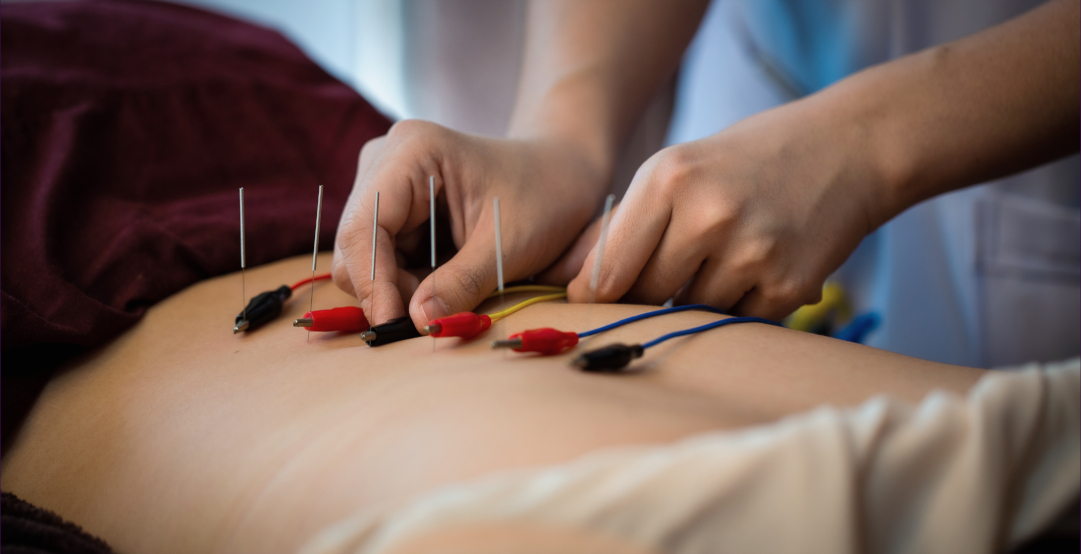 Electro-Acupuncture being applied to a persons back.