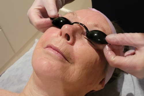 IPL skin treatment with protective eyewear at Ella Baché Hobart