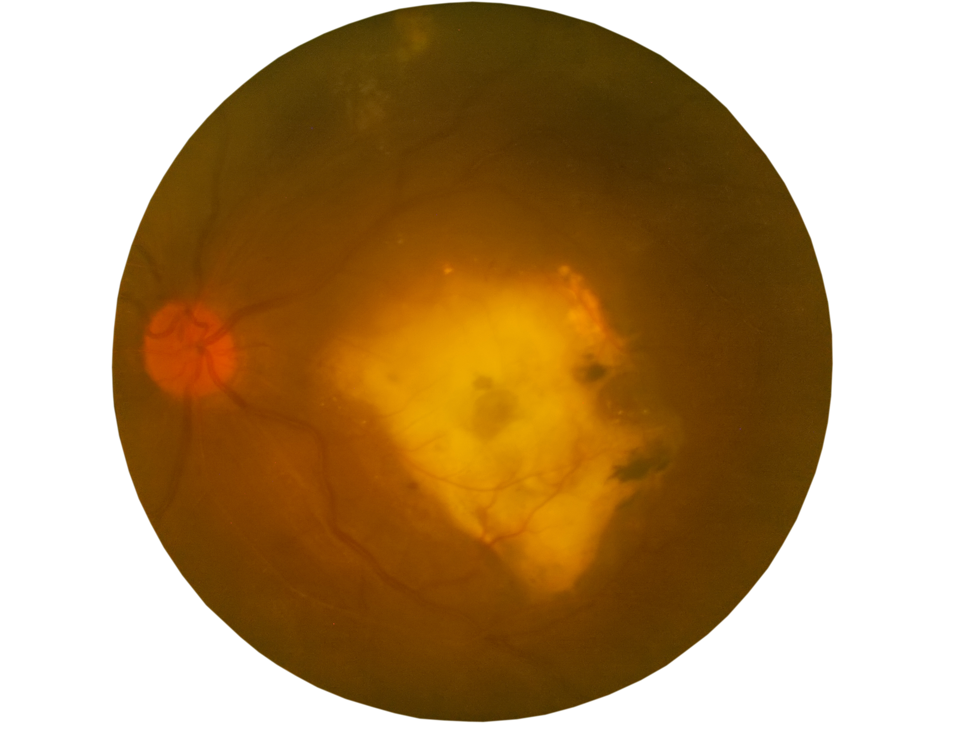 Wet Macular Degeneration Retinal Image