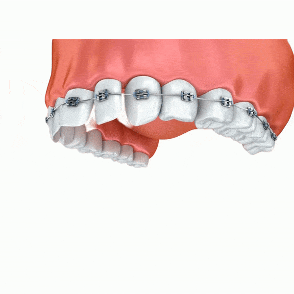 aparelho ortodontico