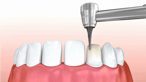 lente de contato dental dentista olegario barra da tijuca rj