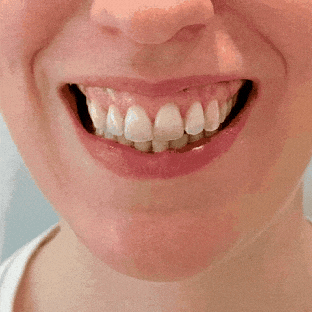 gengivoplastia gengivectomia vila isabel rio de janeiro