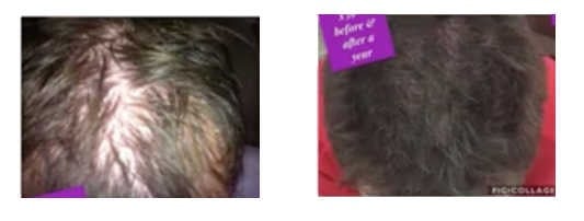 Stem Cell Patch Hair Thicker