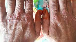 guttate psoriasis on the hands