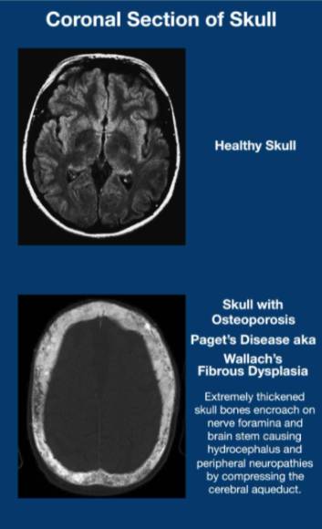 Healthy skull compared to osteoporosis