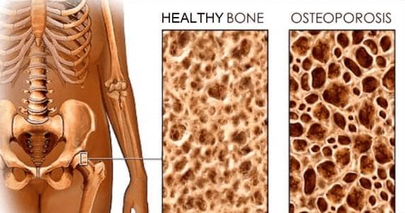 Healthy bone compared to osteoporosis